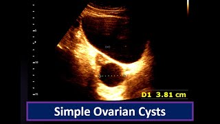 Understanding Simple Ovarian Cysts Ultrasound Findings  Ovarian Cyst  Simple follicular cyst [upl. by Middleton]