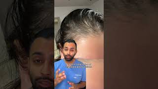 PRP amp Polynucleotides for Hair Loss Before and After  Dr Somji explains [upl. by Ahtnahc]