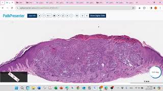 basel cell carcinoma merkel cell carcinoma sebaceous lesion trichoepithelioma [upl. by Harriott]