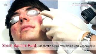 AKNE LIVEBEHANDLUNG  Isolaz und Fraxel Laser  DERMA LOFT Gladbeck [upl. by Aseel]