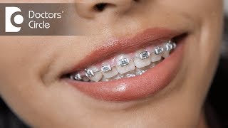 Is weak jaw correction possible with braces  Dr Sumanth M Shetty [upl. by Ruscher]