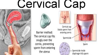 Cervical cap [upl. by Skurnik]