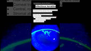 Infectious keratitis [upl. by Isus708]