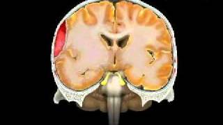 Hematoma Epidural Epidural Hematoma [upl. by Kinch172]