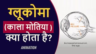 What is Glaucoma  ग्लूकोमा क्या है  Hindi [upl. by Stefan]