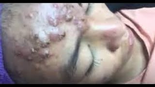 The Most Extreme Blackhead Popping Videos of 2023  satisfying  blackheads  pimple [upl. by Buckels]