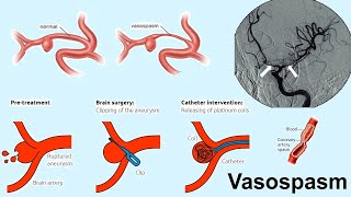 vasospasm [upl. by Idnak678]