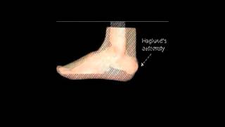 Heel Surgery Haglunds Excision [upl. by Acsecnarf]