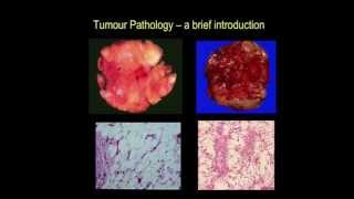 Tumour pathology  a brief introduction part III [upl. by Rikki]