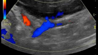 portosystemic shunt through R gastric vein in a dog [upl. by Arym]