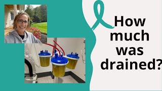 6th Paracentesis to Drain Belly of Fluid Ovarian Cancer Vlog 13 How much did they take [upl. by Brown]