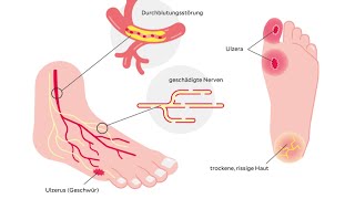 Diabetisches Fußsyndrom [upl. by Raybourne]