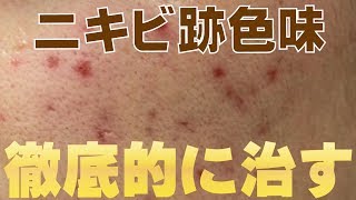 【美容】ニキビ跡で黒・茶色・色素沈着してしまった肌を徹底的に治す方法教えます。 [upl. by Hadnama852]