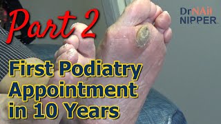 Monster Callus  First Podiatry Appointment in 10 Years Part 2 Callus Tuesday 2023 [upl. by Lilli]