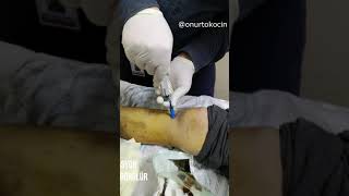 İNTRAOSSEÖZ KEMİK İÇİ – İO YOL AÇILMASI – INTRAOSSEOUS IO CANNULATION [upl. by Harrie996]