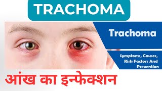 Trachoma रोहे आंख का इन्फेक्शन । कैसे फैलता है और क्यों [upl. by Pernell]