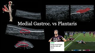 Medial Gastroc vs Plantaris [upl. by Kellyn]