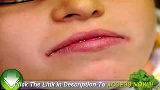 How Angular Cheilitis Cream Works [upl. by Eiramave98]