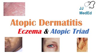 Eczema Atopic Dermatitis  Atopic Triad Triggers Who gets it Why does it happen amp Treatment [upl. by Eirahs337]