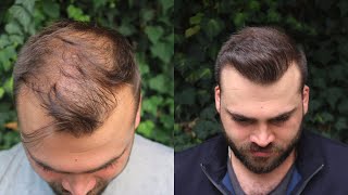 Hair Transplant Result with 3040 Grafts  EXTREME TRANSFORMATION from 0 days to 10 Months [upl. by Pearline]