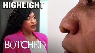 3 BAD Nose Jobs From a Cosmetic Surgeon  Botched  E [upl. by Knight]