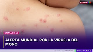 Alerta mundial por la viruela del mono [upl. by Madid923]