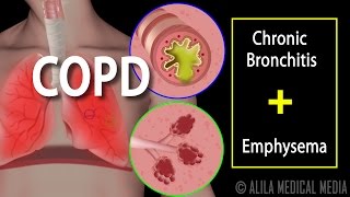 COPD  Chronic Obstructive Pulmonary Disease Animation [upl. by Eeleimaj]