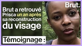 Reconstruction du visage  1 an après Prisca et sa prothèse dœil [upl. by Nommad]