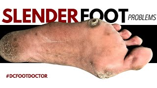 Slender Foot Problems Removing Painful Calluses [upl. by Annabal723]