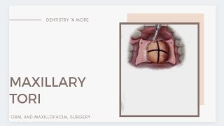 MAXILLARY TORI  MANDIBULAR TORI  PRE PROSTHETIC SURGERY [upl. by Nedmac]