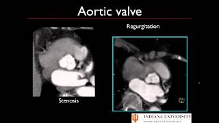 Post Processing Cardiac CT [upl. by Nnylrebma694]