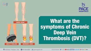 What are the Symptoms of Chronic Deep Vein Thrombosis DVT  PACE Hospitals shortvideo DVT [upl. by Nathanial983]