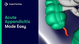 Appendicitis Made Easy  A Complete Revision Guide [upl. by Zeuqcaj]