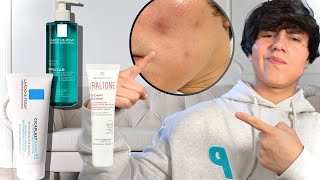 COMO CURAR LA DERMATITIS SEBORREICA  MI EXPERIENCIA [upl. by Carn783]