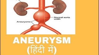 ANEURYSM BY DRPawan Gupta [upl. by Wartow]