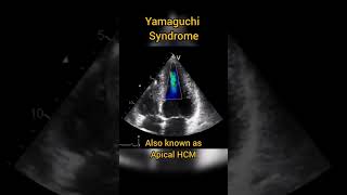 Apical Hypertrophic Cardiomyopathy HCM or Yamaguchi syndrome echocardiography [upl. by Ivie]