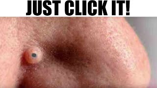 Greatest Pops Pimples Comedones Cysts and Cystic Acne [upl. by Tracie]