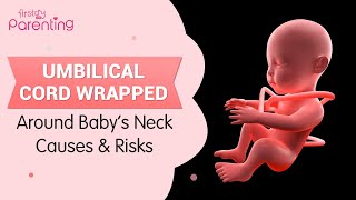 Umbilical Cord Around Babys Neck Nuchal Cord  Causes Risks and Prevention [upl. by Susejedairam]