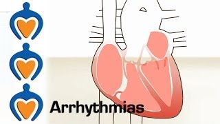 Arrhythmias  What is an arrhythmia and how is it treated [upl. by Siroved989]