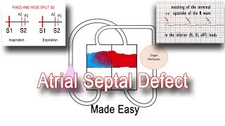 Atrial Septal Defect ASD Pathophysiology amp Clinical Features [upl. by Anawait]