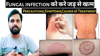 Fungal infection को करें जड़ से खत्म  fungal infection treatment in hindi MedicalJankari [upl. by Risser]