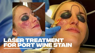 Treating a PortWine Stain with Excel V Laser at Contour Dermatology [upl. by Halle]