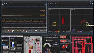 VAECMO and Impella Donker DW et al [upl. by Isolt]