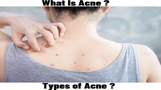 What Is Acne Types Of Acne [upl. by Eseilana]