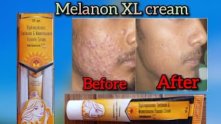 चेहरे में काले दाग पिंपल Redness swelling  Melanon XL cream uses in hindi [upl. by Nedroj464]