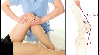 Реабилитация после операции коленного сустава  Treatment of knee contracture [upl. by Safier]