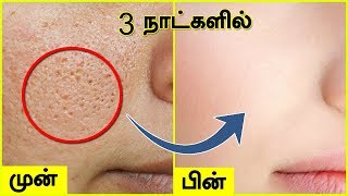 முகத்தில் உள்ள சிறுசிறு குழிகள் OPEN PORES மறைய  Open Large Pores on Face [upl. by Kirtap235]