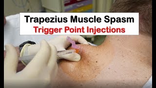 Trapezius Muscle Spasm Trigger Point Injection [upl. by Necila]