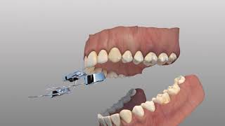 Rapid Palatal Expander [upl. by Bessie]