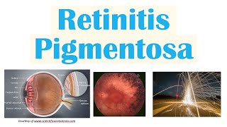 Retinitis Pigmentosa  Genetics Pathophysiology Signs amp Symptoms Diagnosis Treatment [upl. by Corkhill]